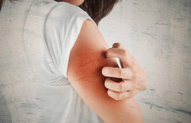 Eczema and Psoriasis