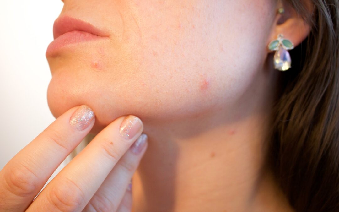 Acne | Could your Diet be a Source of the Problem?